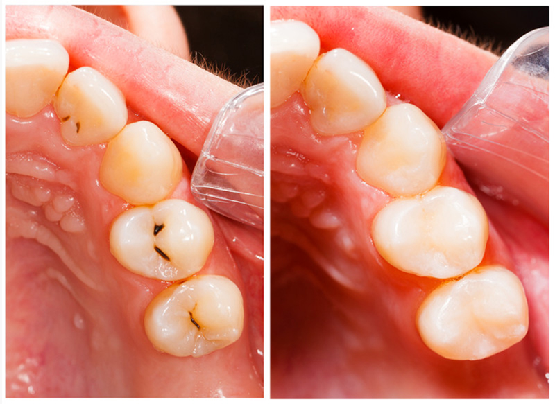 Fillings  Clinton, MA 