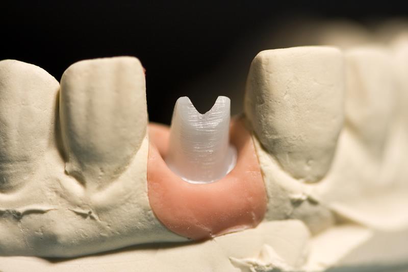 Implant Restoration  Clinton, MA 