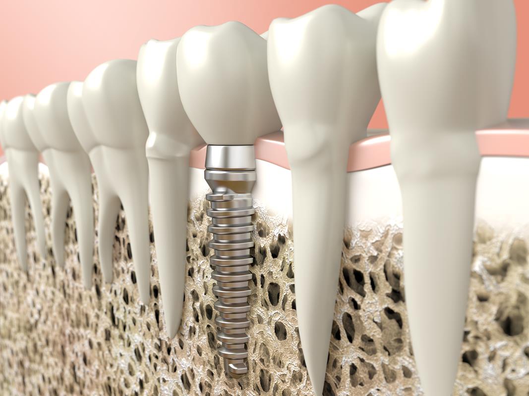 Dental Implants  Clinton, MA 