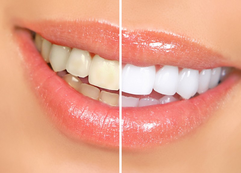 Teeth Whitening  Clinton, MA 