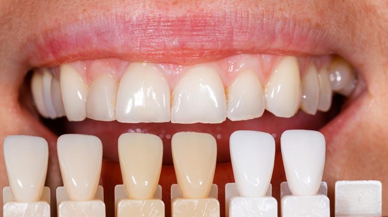 Veneers  Clinton, MA 